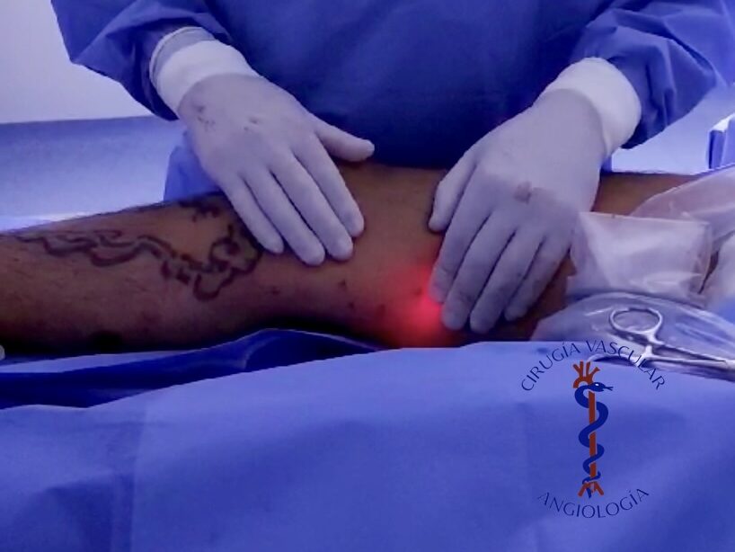 Screenshot Ablasion Laser de Safena